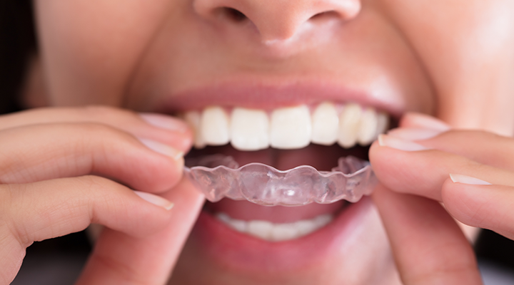 Photo of woman putting in aligner.